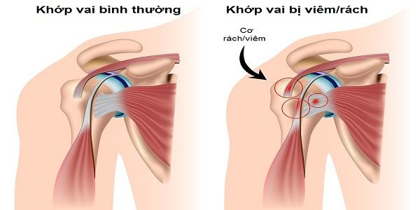 Nguyên do dẫn đến bệnh viêm quanh khớp vai