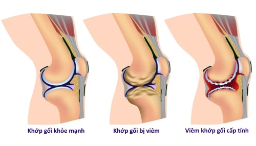 Nguyên do gây ra viêm khớp gối