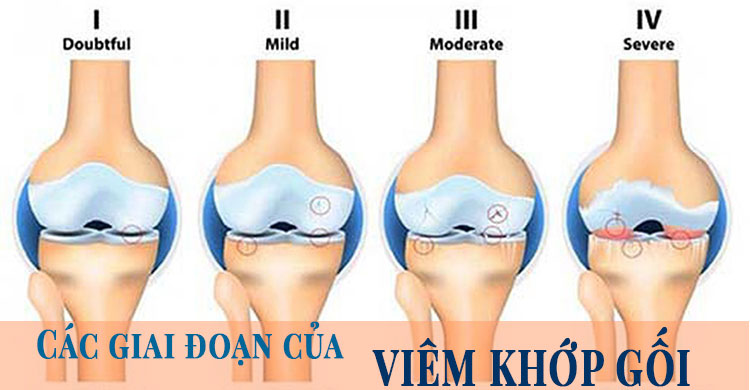 Những giai đoạn phát triển của bệnh viêm khớp gối