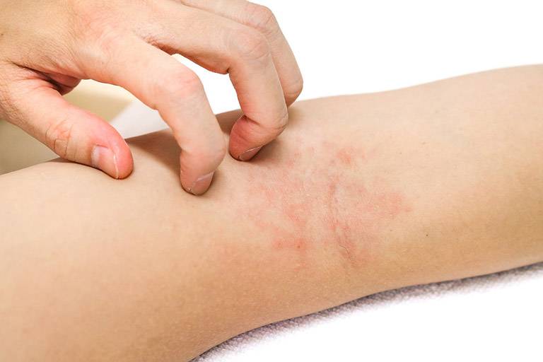 chữa viêm da cơ địa
