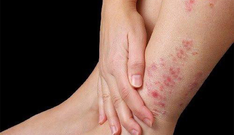 viêm da cơ địa ở chân