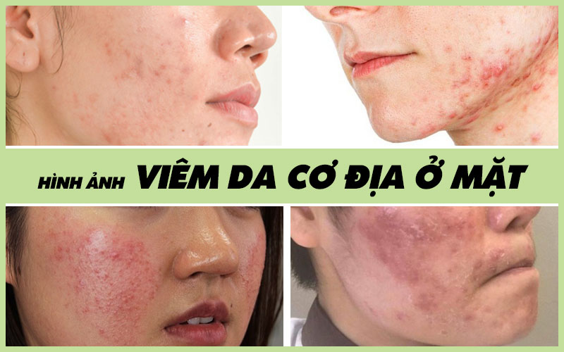 Nguyên nhân bị Viêm da cơ địa ở mặt