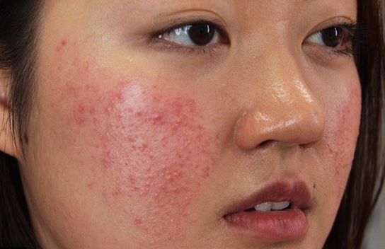 Chữa trị viêm da cơ địa ở mặt người lớn
