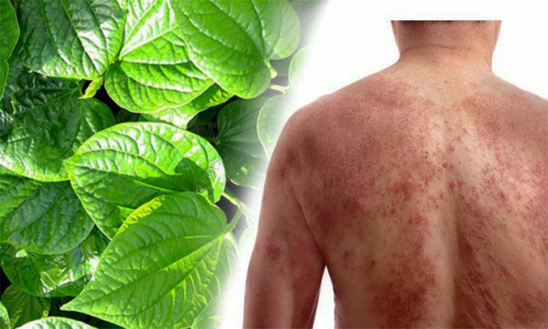 Đắp lá trầu không trị viêm da cơ địa ở mặt