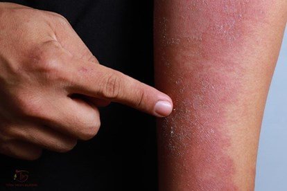 Viêm da cơ địa ở người trưởng thành nguy hiểm không?
