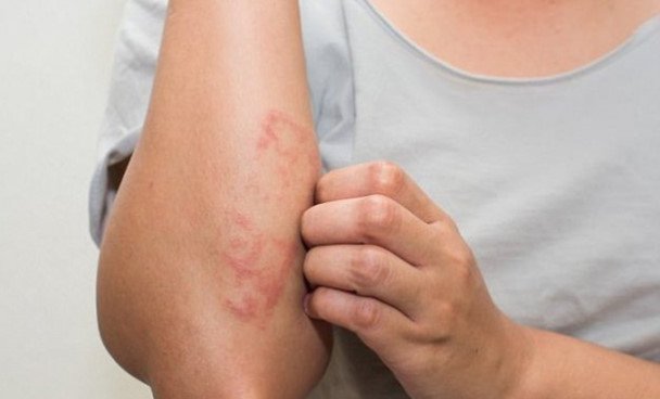 Cách chữa viêm da cơ địa ở người lớn
