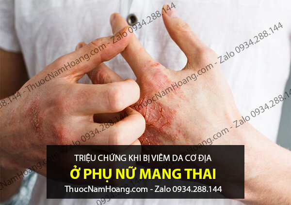 Triệu chứng nhận biết viêm da cơ địa ở bà bầu