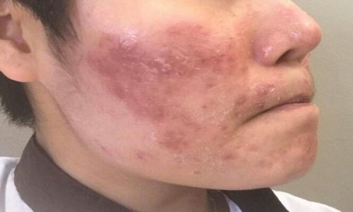 Bệnh viêm da cơ địa bội nhiễm