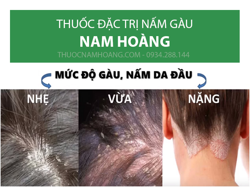 Thuốc chữa gàu nấm da đầu Đông y Nam Hoàng dành cho ai?