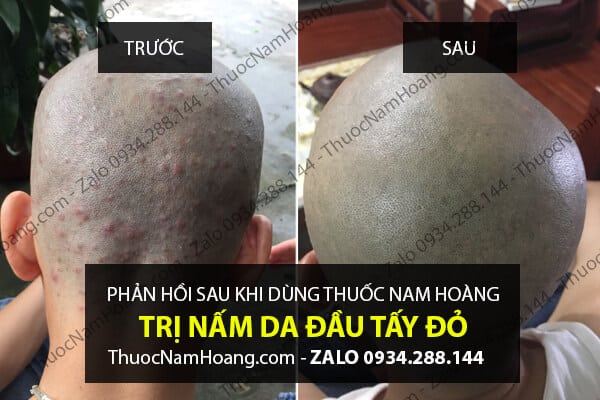 Cách sử dụng Thuốc trị gàu nấm da đầu Đông y Nam Hoàng