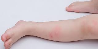 Dùng lá tắm giảm Bé bị sốt nổi mẩn ngứa