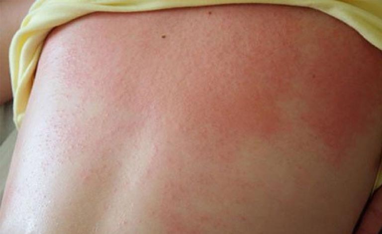 Bé bị sốt nổi mẩn ngứa