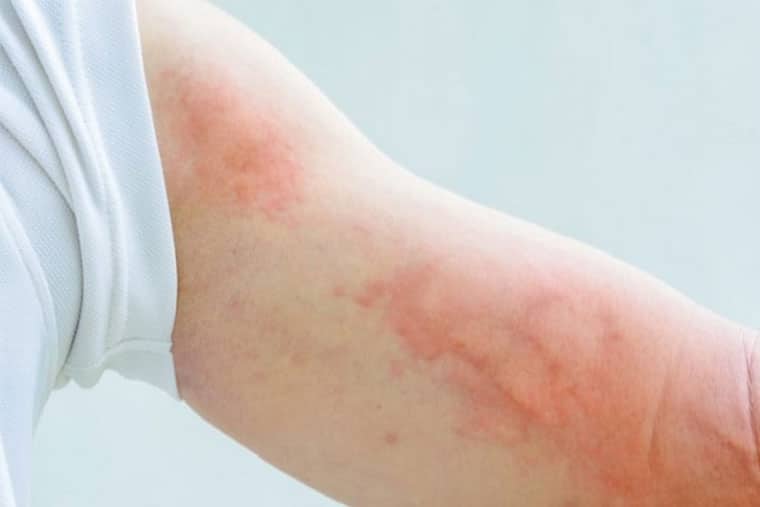 Cách chữa trị mẩn ngứa thành mảng bằng thuốc tây