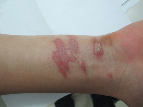 Cách nhận biết vết bóng nước do côn trùng cắn