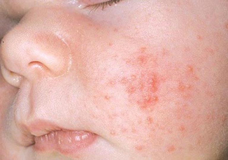 Điều trị vết côn trùng cắn bị bóng nước