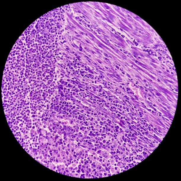 Uterus wall consist pyometra with cervicitis, photomicrograph show dense infiltration of polymorphs, lymphocytes, histiocytes and necrotic material. Uterus wall consist pyometra with cervicitis, photomicrograph show dense infiltration of polymorphs, lymphocytes, histiocytes and necrotic material. pyometra dog stock pictures, royalty-free photos & images