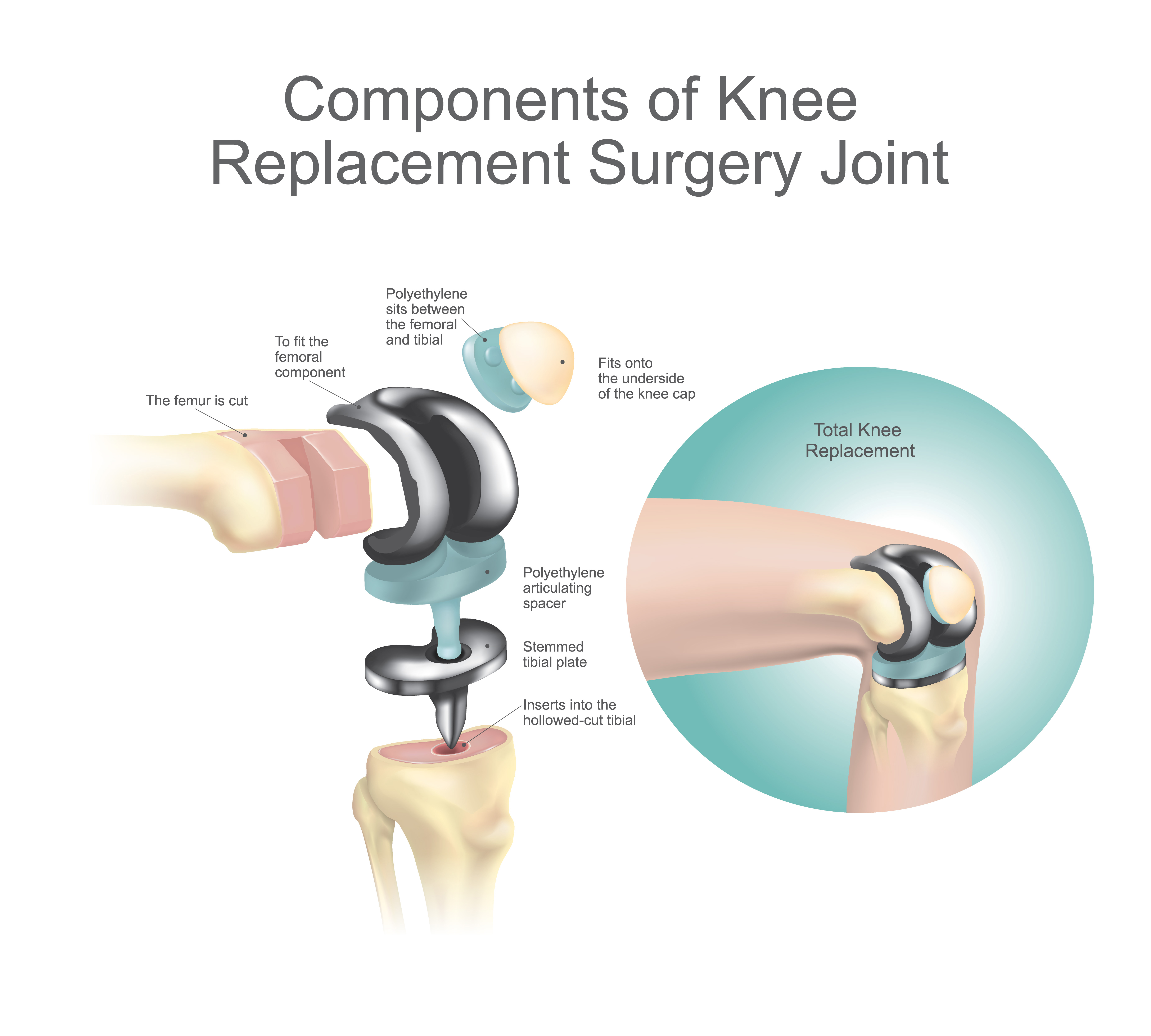 blog-glue-and-knee-replacement