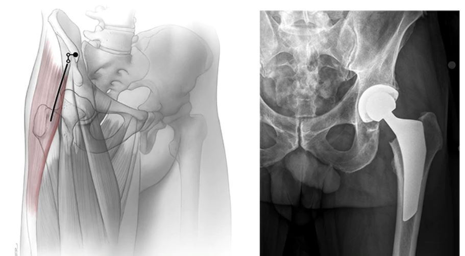 hip replacement radiograph