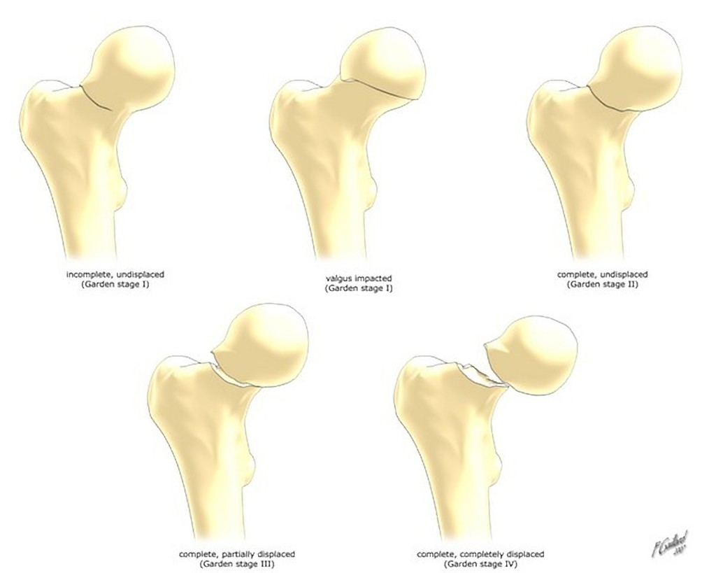 femoral neck fracture classification diagram