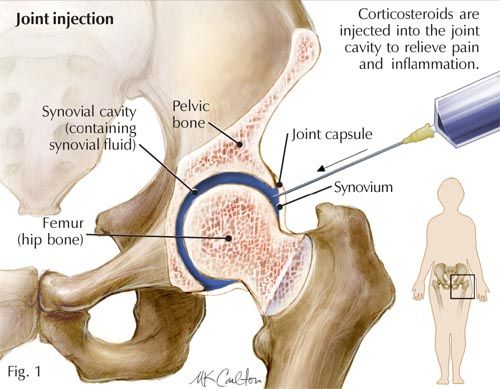 hip joint injection infographic