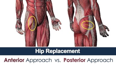 Posterior Hip Replacement Incision Diagram