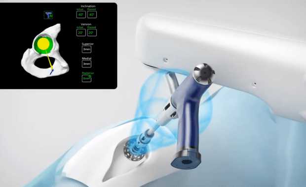 Mako robotic hip replacement