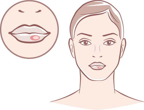 Skin Infections