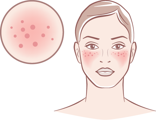 Skin Cancers
