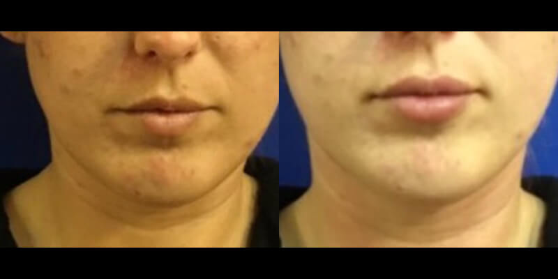 Before & After
