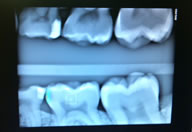 Logicon Caries (Decay) Detection