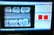 Digital X-Rays