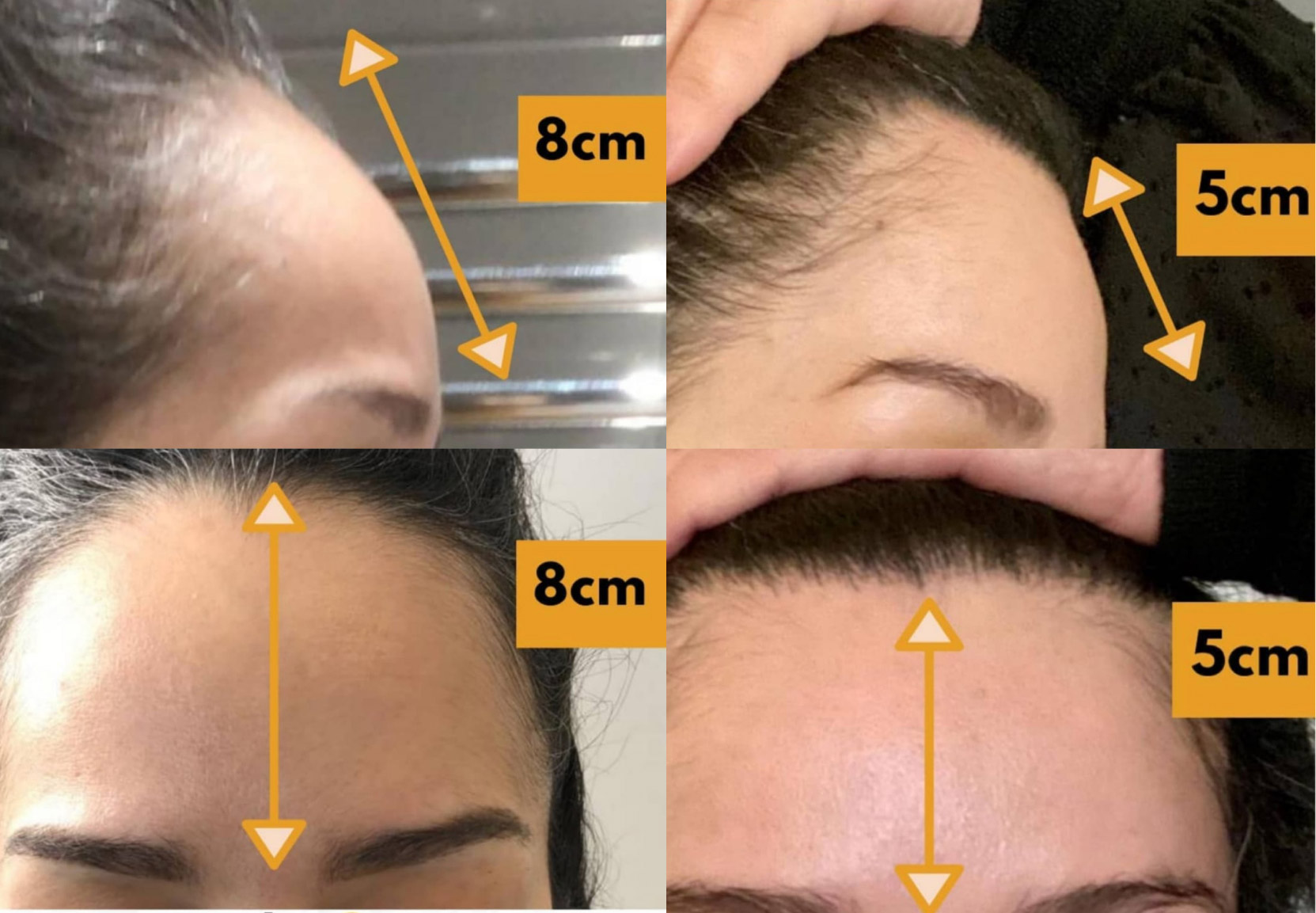 What makes FUE Hair Transplant Procedure the most Successful Technique?