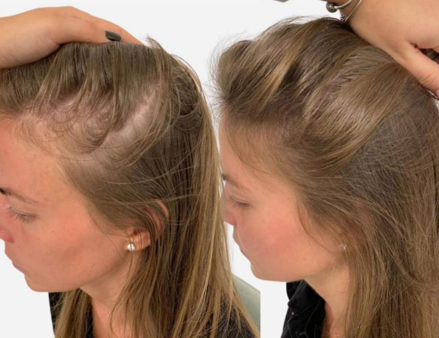 women hair loss treatment result