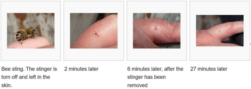 Bee Sting on Finger