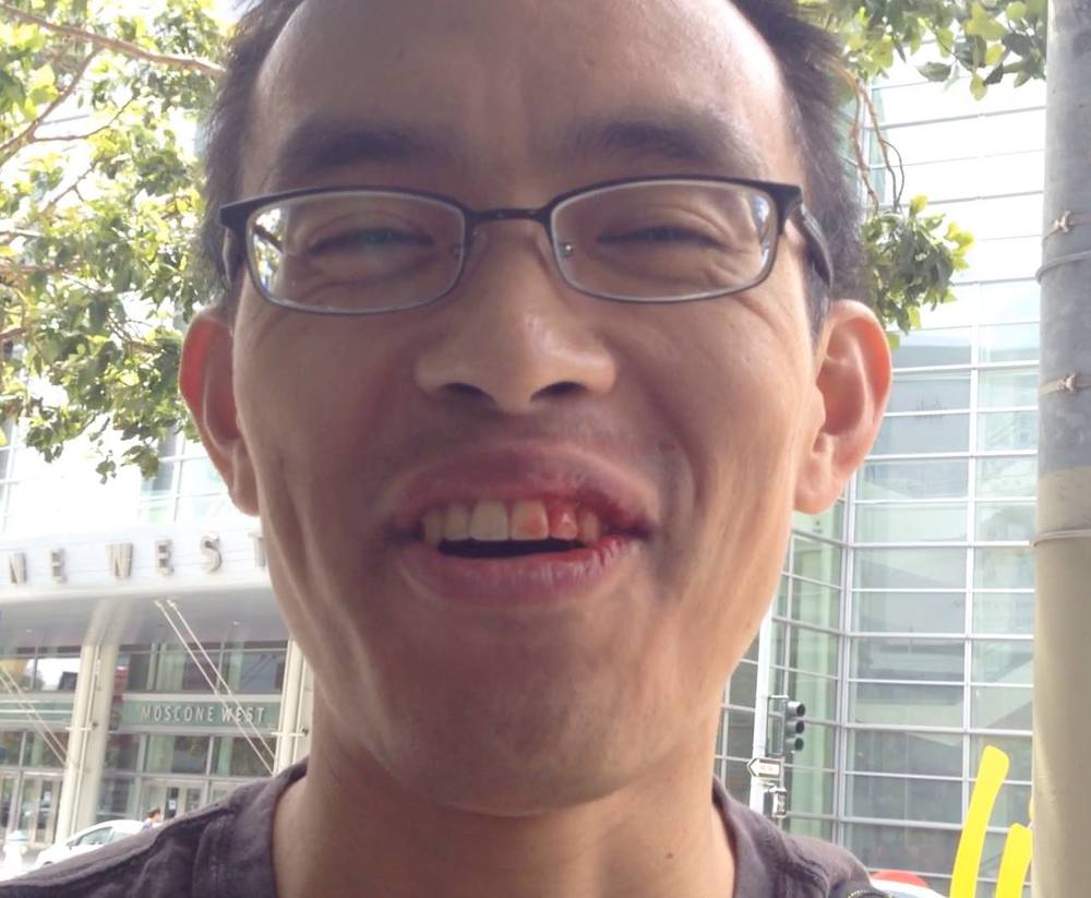 Punched in the face at a demonstration in May 2014, but still smiling!
