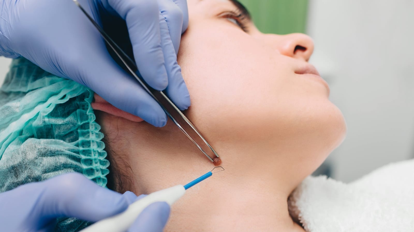 Low scarring mole removal now available Spot Check skin cancer