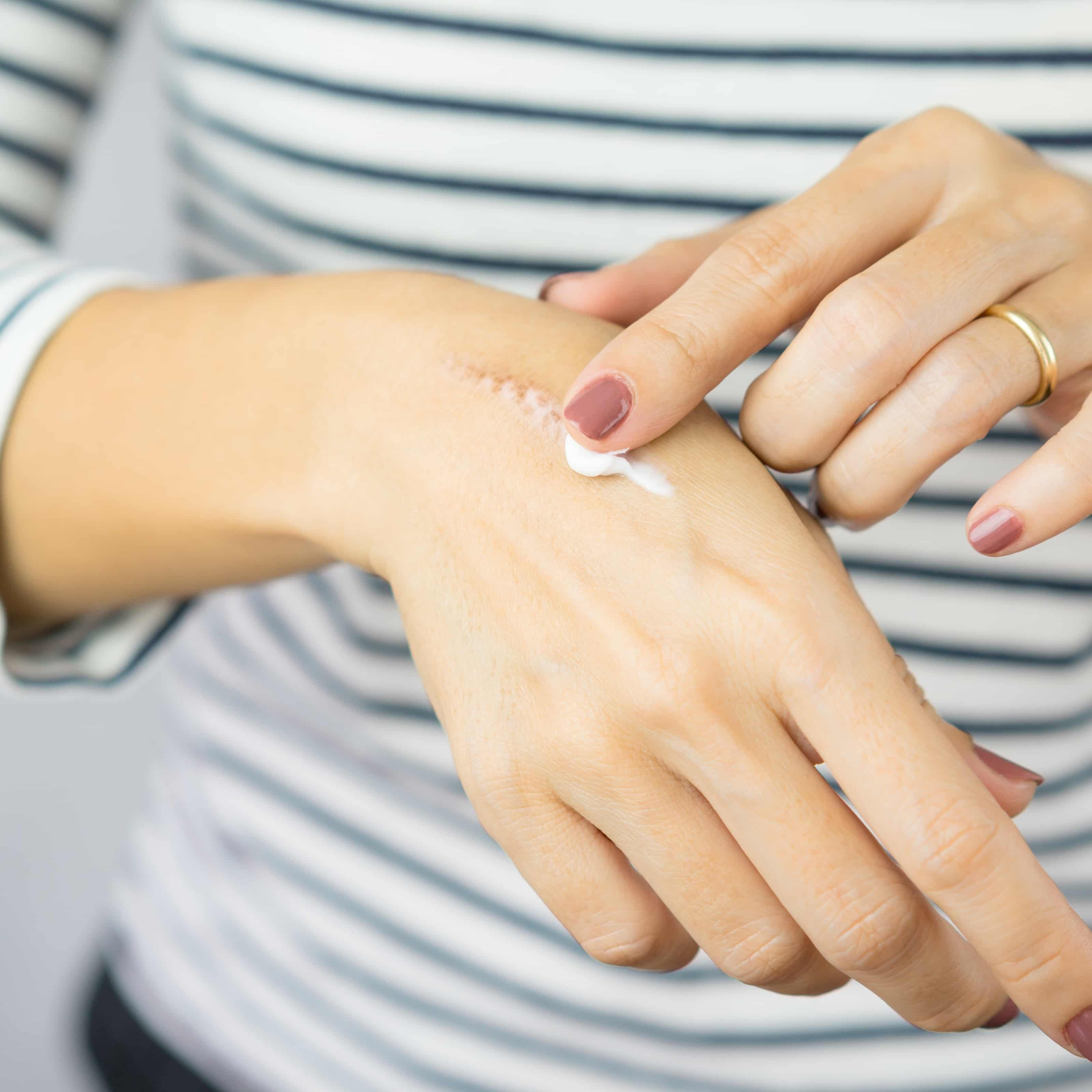 Shave biopsy and excision Spot Check Clinic