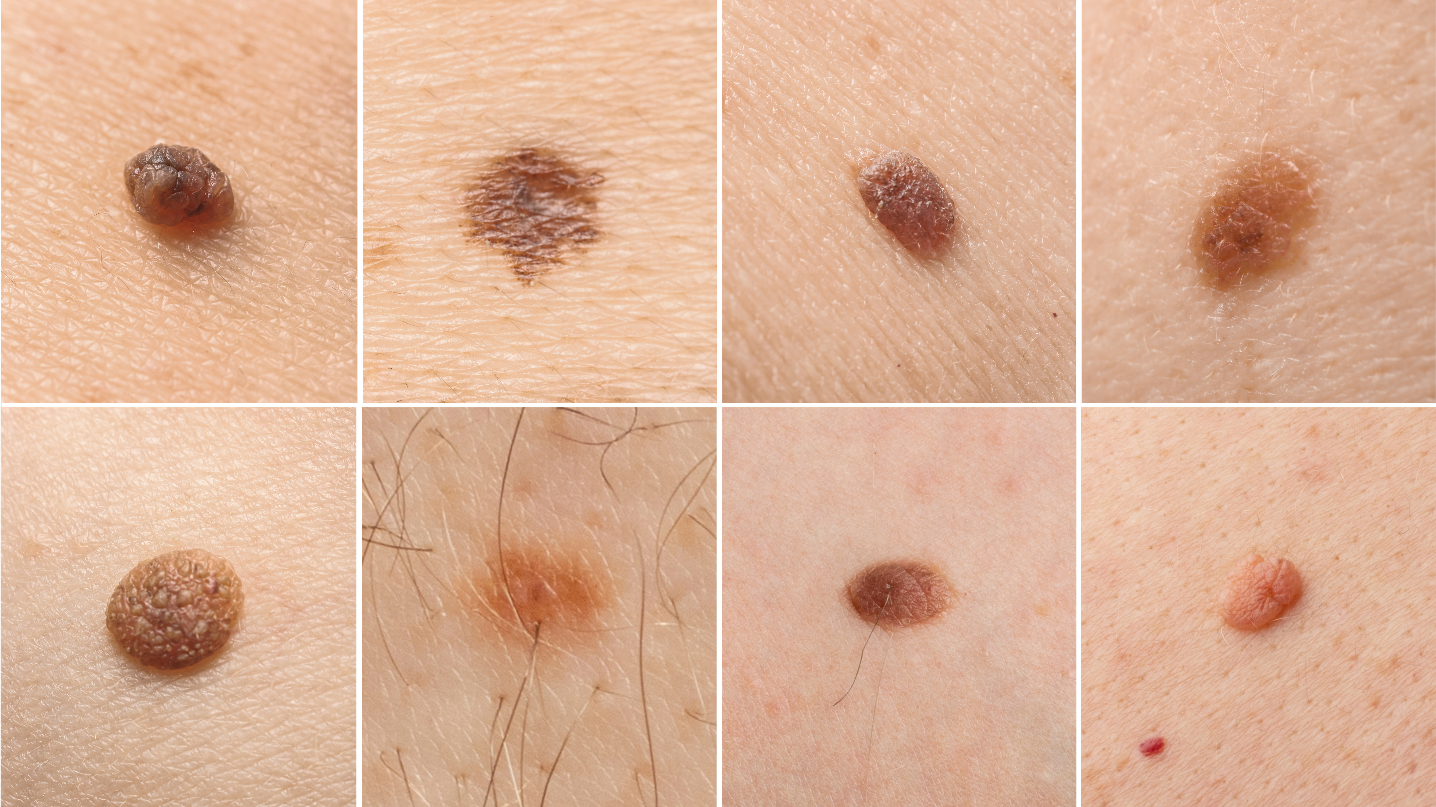 Skin Moles Types