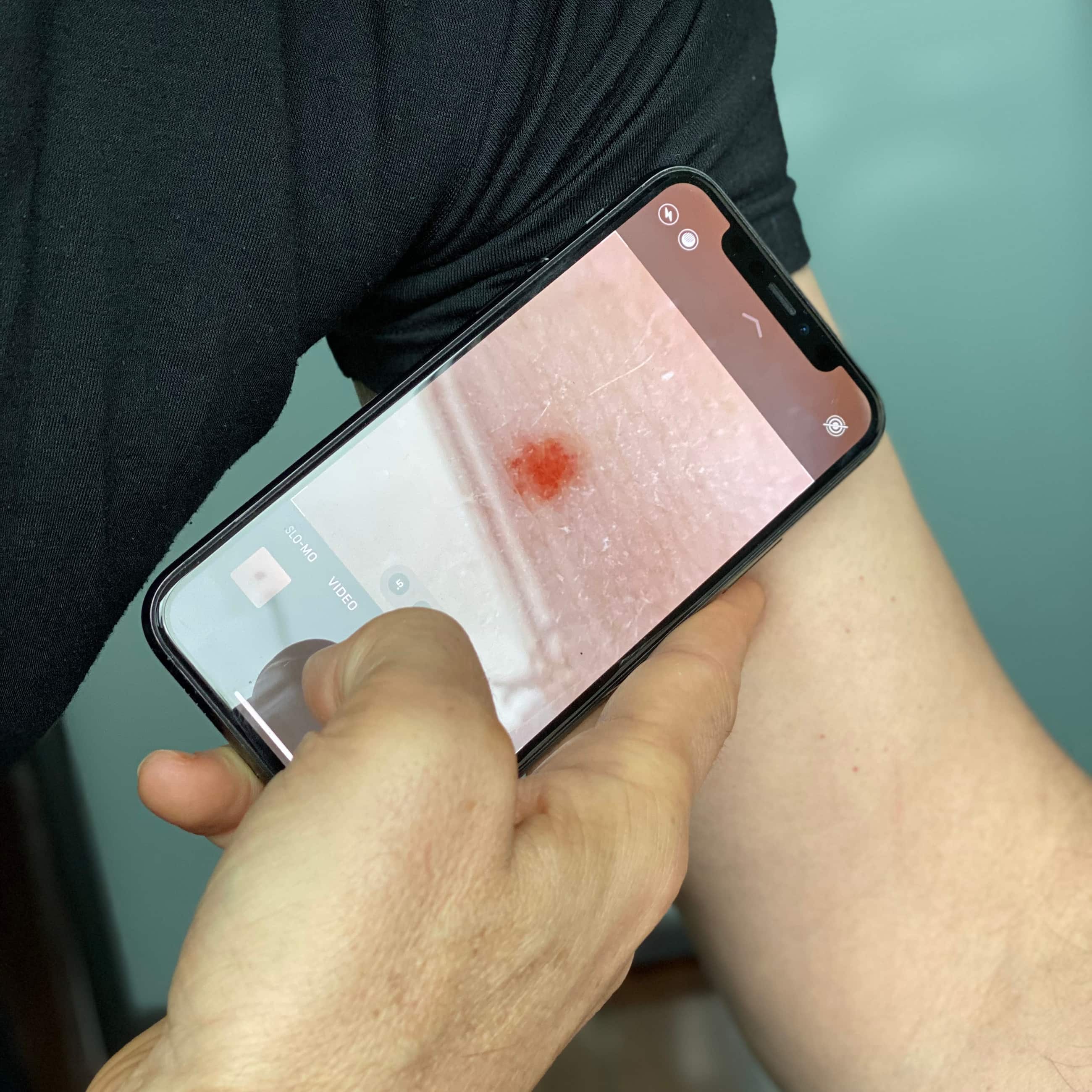 Cosmetic mole removal lowscarring removal of moles, skin tags, age