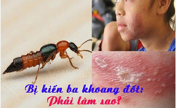 trị sẹo kiến ba khoang