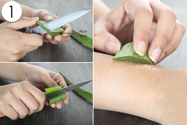 nha đam chữa bỏng