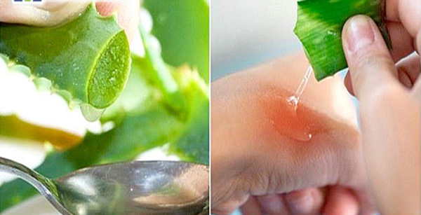 cách chữa bỏng bằng nha đam