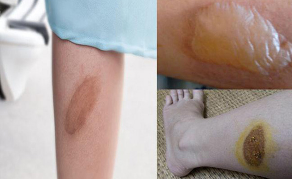 vết thương bỏng bị chảy nước vàng