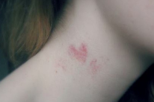 Hickey là gì?
