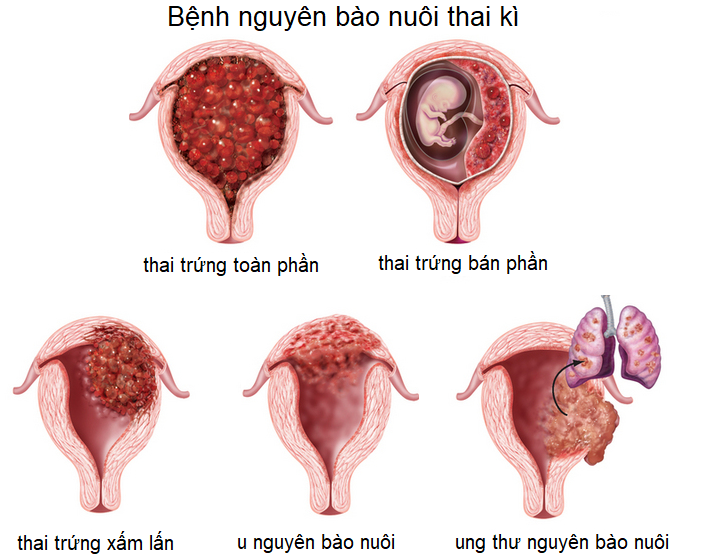 Thai trứng là gì