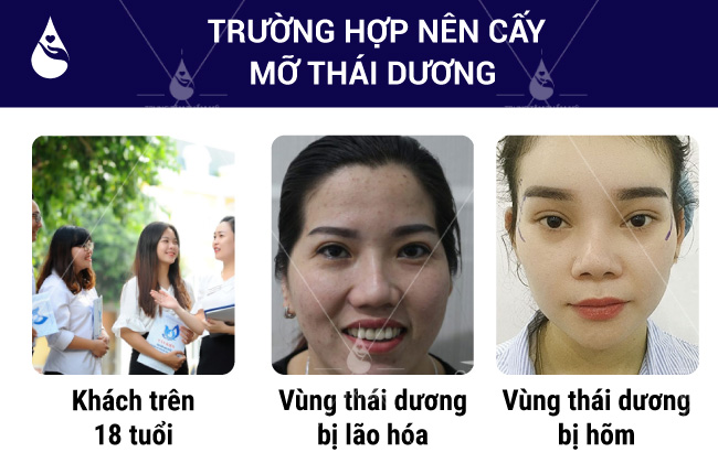 Trường hợp nên cấy mỡ thái dương