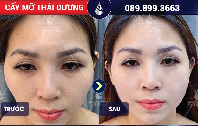 Hiệu quả sau khi cấy mỡ thái dương