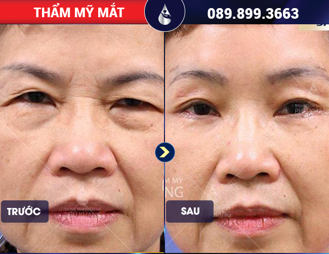 Khách hàng nâng cung chân mày