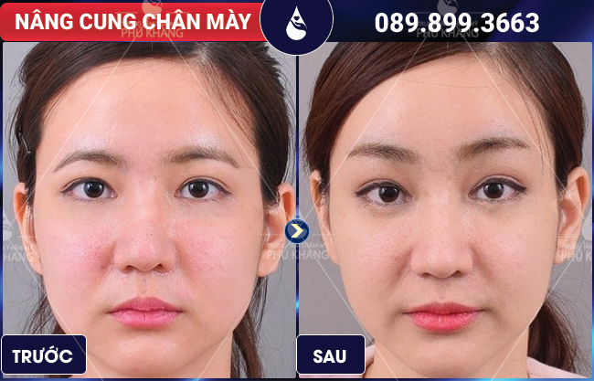 Nâng cung chân mày đẹp