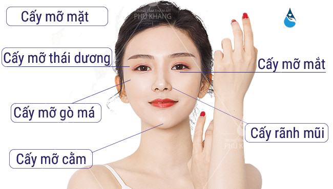 Cấy mỡ tự thân - Cấy mỡ thái dương